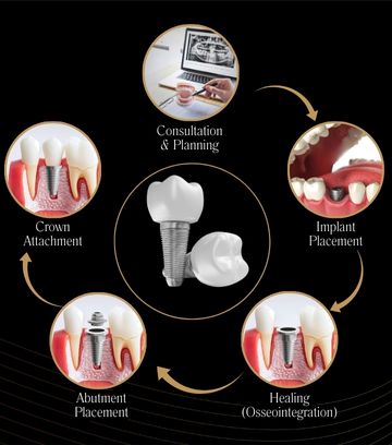 Tooth Implants in Jeevan Bima Nagar
